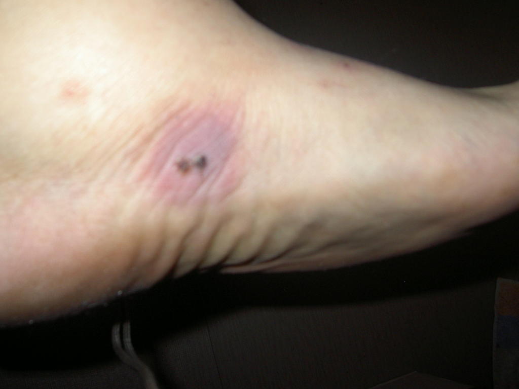 001 kyykäärme haukkasi jossain venäjällä tältä näyttää vajaan viikon jälkeen ihmettelinkin kun oli koipi puuduksissa turvoksissa torstaina huomasin kyllä verijäljet jalassa epäilin oksan aiheuttamaksi .